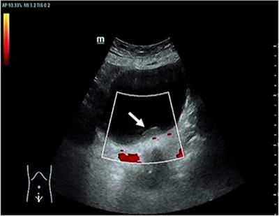 Rare primary bladder mucosa-associated lymphoid tissue lymphoma: A case report and review of literature